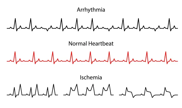 EKG-Untersuchung